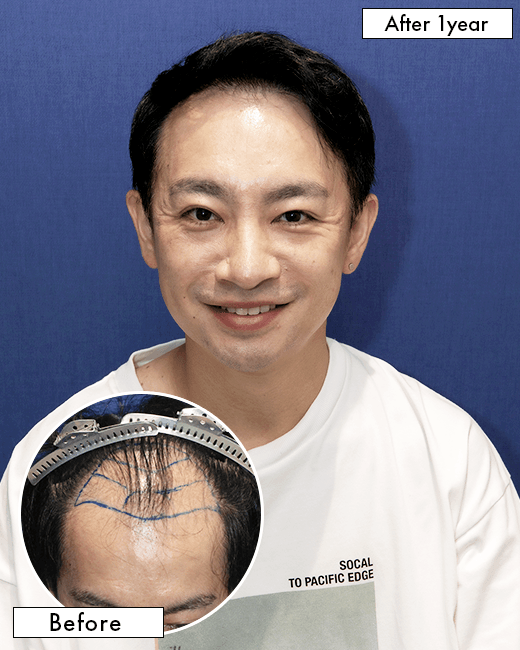 S.Tさんの上半身写真（施術後）