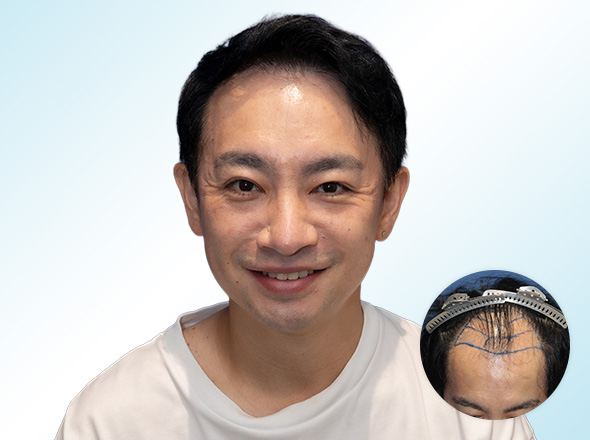 30代男性S.Tさんの上半身写真（施術後）＋施術前写真