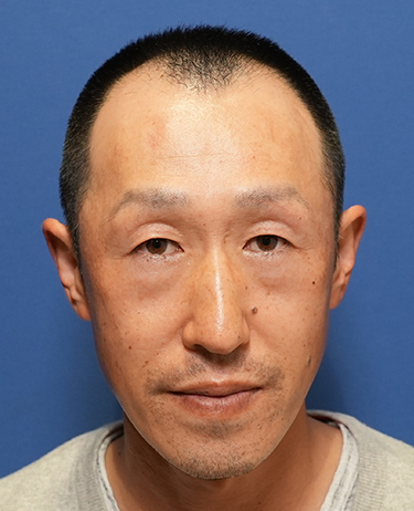 男性 Y.Jさんの顔写真（施術前）