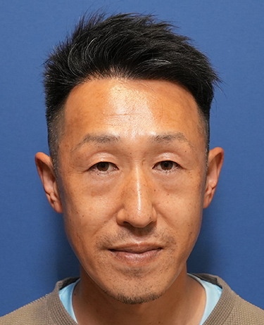 男性 Y.Jさんの顔写真（術後）
