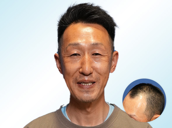 40代男性Y.Jさんの上半身写真（施術後）＋施術前写真
