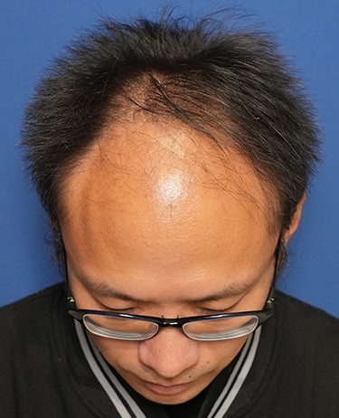 男性 E.Hさんの顔写真（施術前）