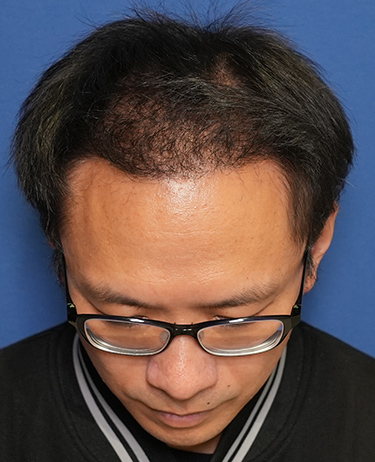 男性 E.Hさんの顔写真（術後6ヶ月）