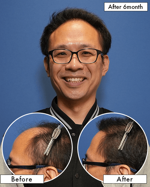 E.Hさんの上半身写真（施術後）