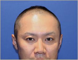 30代 男性 T.Mさんの顔写真（施術前）