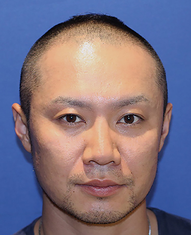 30代 男性 T.Mさんの顔写真（施術前）