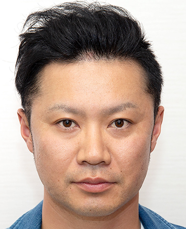 30代 男性 T.Mさんの顔写真（1年2ヶ月後）