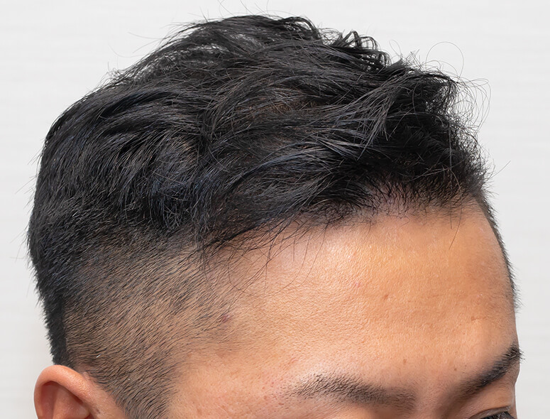30代 男性 T.Mさんの頭部写真3（3年後）