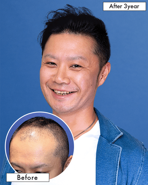 30代 男性 T.Mさんの上半身写真（施術後）