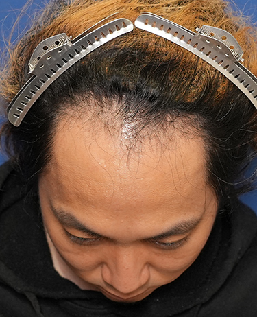 男性 T.Yさんの顔写真（施術前）