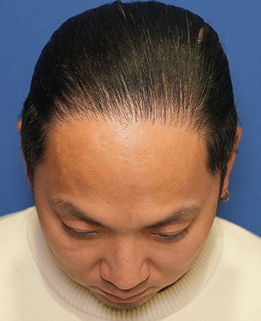 男性 T.Yさんの顔写真（術後1年）