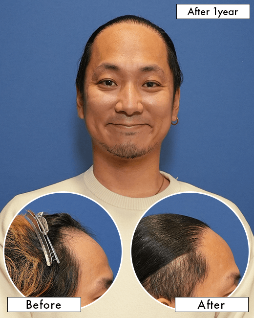 T.Yさんの上半身写真（施術後）