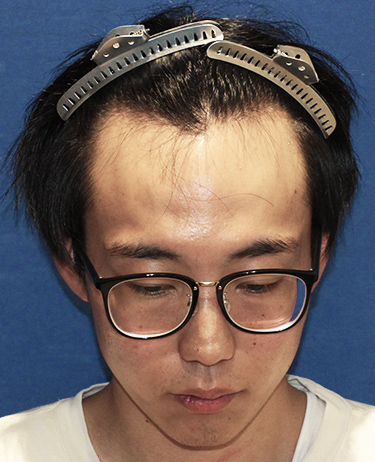 男性 K.Yさんの顔写真（施術前）