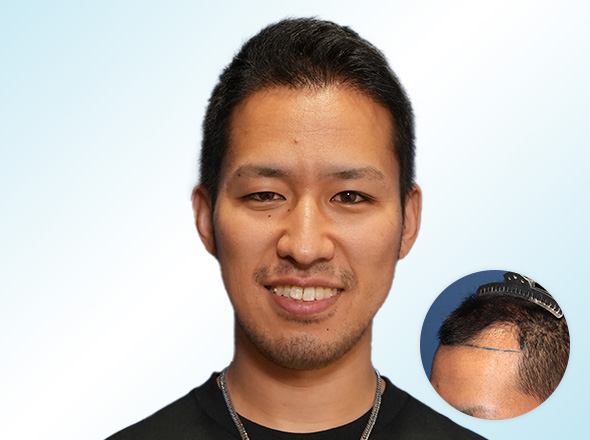 30代男性F.Kさんの上半身写真（施術後）＋施術前写真