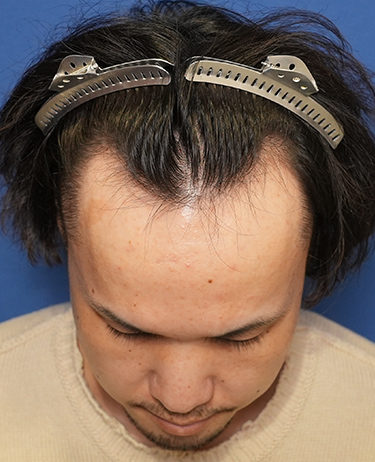 男性 O.Gさんの顔写真（施術前）