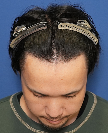 男性 O.Gさんの顔写真（術後1年）