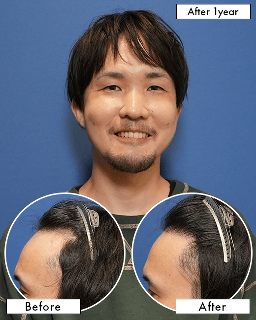 O.Gさんの上半身写真（施術後）