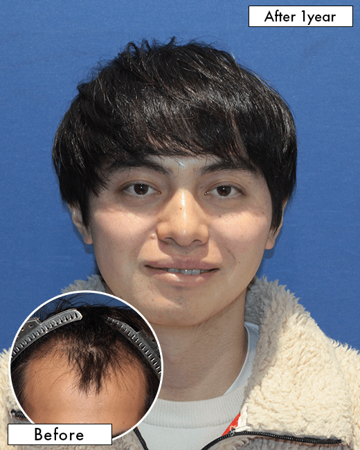 S.Rさんの上半身写真（施術後）