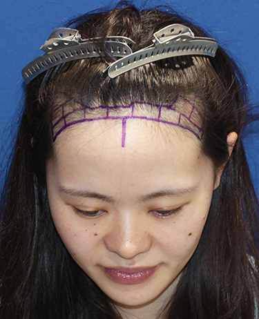 女性 A.Kさんの顔写真（施術前）