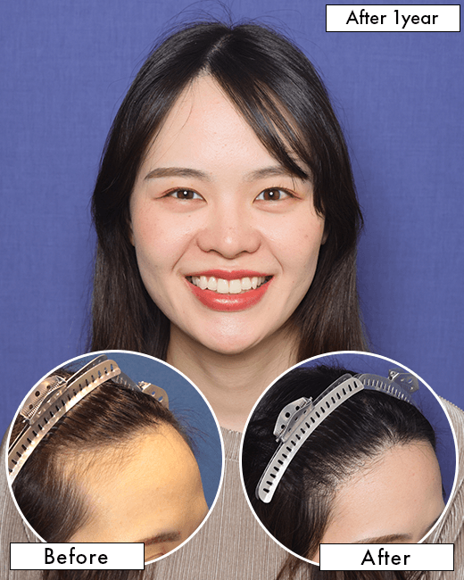A.Kさんの上半身写真（施術後）