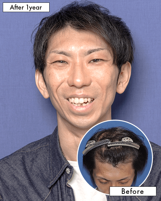 S.Y.さんの上半身写真（術後6ヶ月）