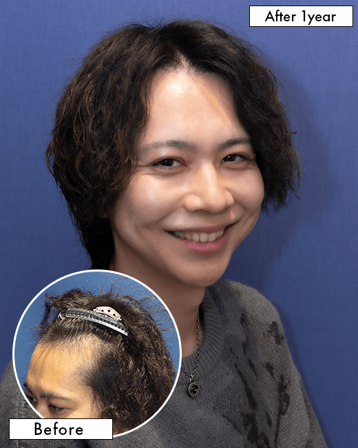 O.K.さんの上半身写真（術後6ヶ月）