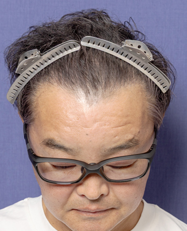 男性 A.R.さんの顔写真（術後6ヶ月）