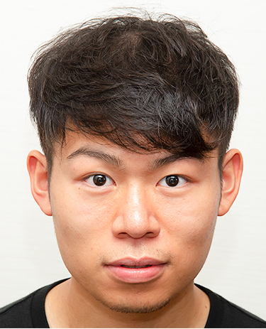 20代 男性 K.Kさんの顔写真（術前）