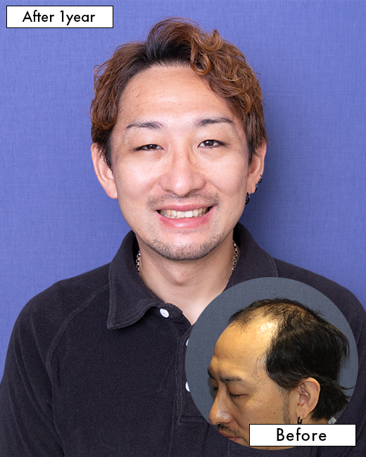 生え際の自毛植毛症例（30代）：上半身写真（術後1年）