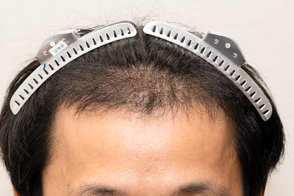 ホワイトベース二宮さんの手術後5ヶ月後の生え際