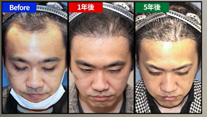 自毛植毛手術5年後の〇〇さん（〇代・男性）自毛植毛手術（5年後の経過）