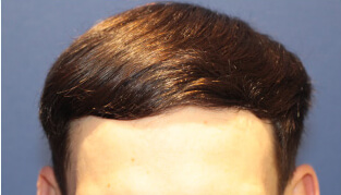 20代 男性 R.S.さん 前頭部・頭頂部の自毛植毛（MIRAI法） 1,400株の症例（施術後）