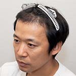 インタビュー動画公開中　術後5か月目にして喜びの声多数！