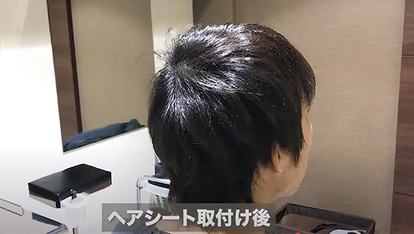 YouTuber二宮祥平さん 自毛植毛 体験記 手術偏_10