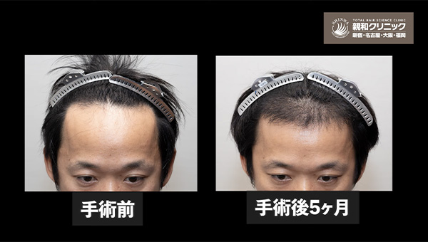 YouTuber二宮祥平さん 自毛植毛 体験記 5ヶ月偏_01