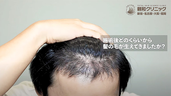 YouTuber二宮祥平さん 自毛植毛 体験記 5ヶ月偏_03