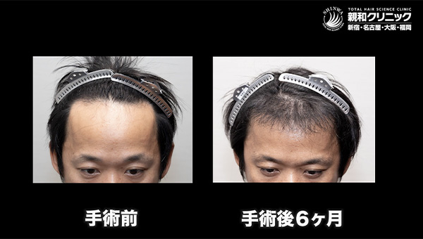 YouTuber二宮祥平さん 自毛植毛 体験記 6ヶ月偏_01
