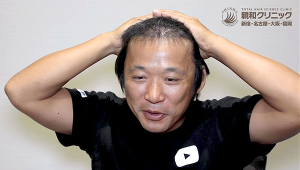 YouTuber二宮祥平さん 自毛植毛 体験記 6ヶ月偏_02