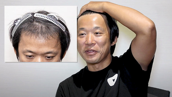 YouTuber二宮祥平さん 自毛植毛 体験記 6ヶ月偏_03