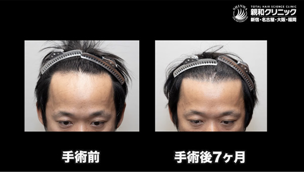 YouTuber二宮祥平さん 自毛植毛 体験記 7ヶ月偏_01