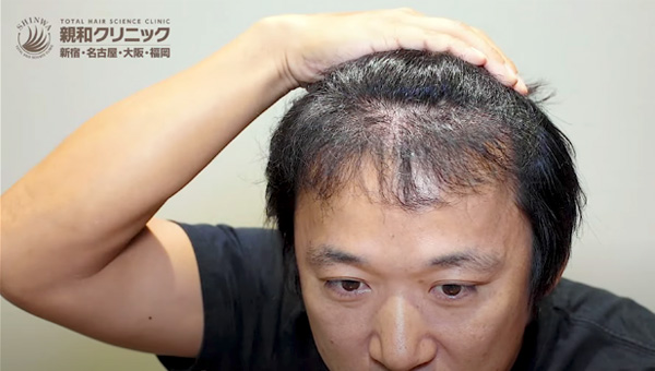 YouTuber二宮祥平さん 自毛植毛 体験記 7ヶ月偏_02