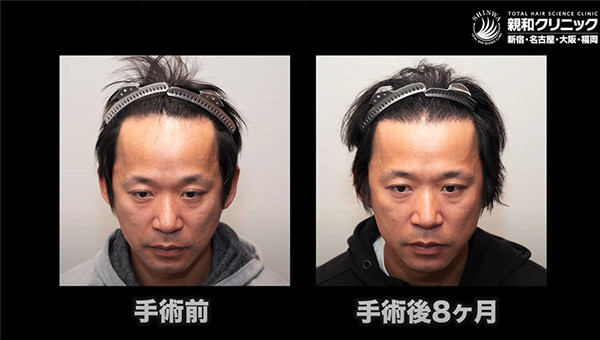 YouTuber二宮祥平さん 自毛植毛 体験記 8ヶ月偏_01