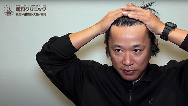 YouTuber二宮祥平さん 自毛植毛 体験記 8ヶ月偏_02