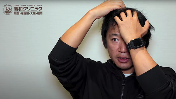 YouTuber二宮祥平さん 自毛植毛 体験記 8ヶ月偏_04