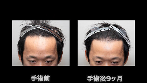 YouTuber二宮祥平さん 自毛植毛 体験記 9ヶ月偏_01