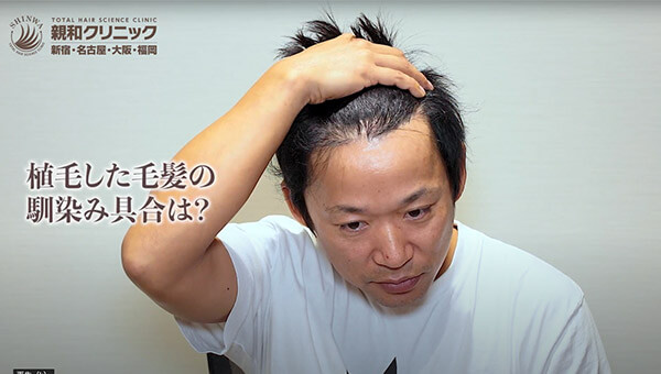 YouTuber二宮祥平さん 自毛植毛 体験記 9ヶ月偏_02