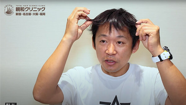 YouTuber二宮祥平さん 自毛植毛 体験記 9ヶ月偏_04