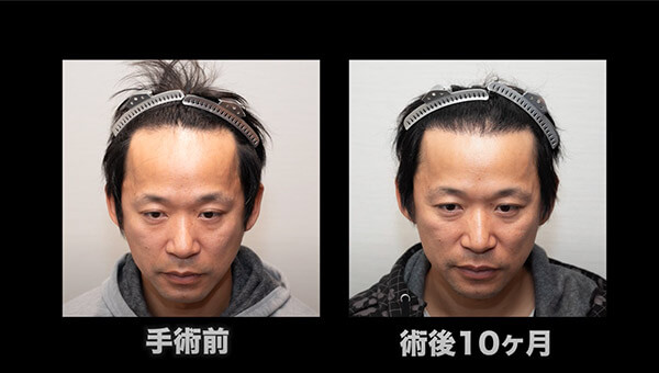 YouTuber二宮祥平さん 自毛植毛 体験記 10ヶ月偏_01