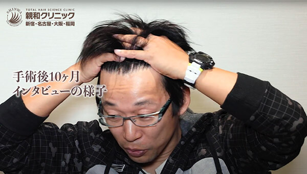 YouTuber二宮祥平さん 自毛植毛 体験記 10ヶ月偏_03