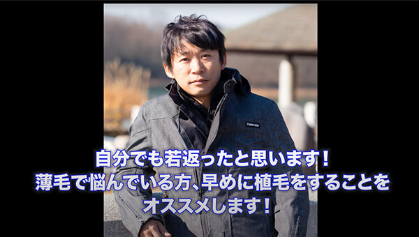YouTuber二宮祥平さん 自毛植毛 体験記 12ヶ月偏_01